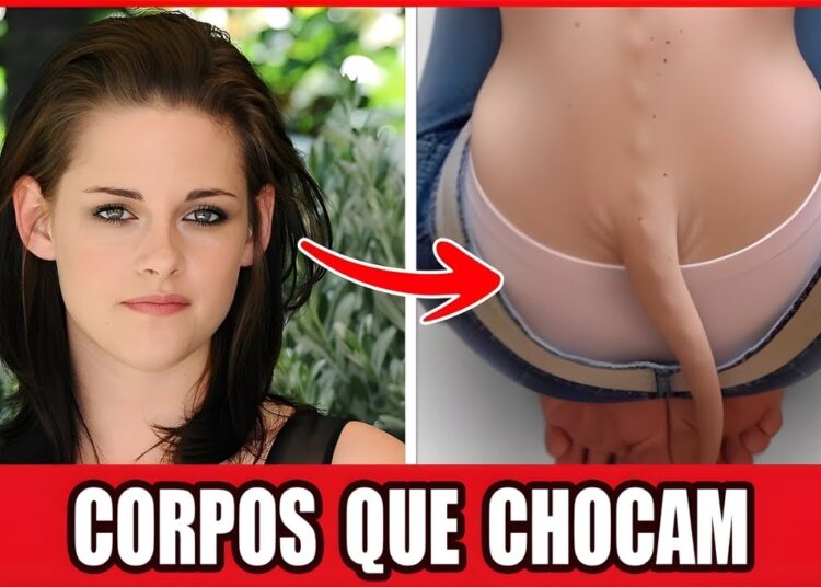 36 Famosos Com Estranhas Deformidades Corporais Que Chocaram o Público