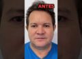 Ximbinha ANTES E DEPOIS da harmonização facial #shorts