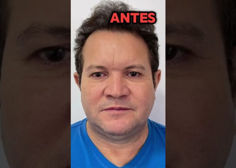 Ximbinha ANTES E DEPOIS da harmonização facial #shorts
