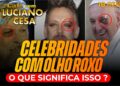 CELEBRIDADES com OLHO ROXO. O QUE ISSO SIGNIFICA? LUCIANO CESA CAFÉ. Compartilhem!