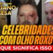 CELEBRIDADES com OLHO ROXO. O QUE ISSO SIGNIFICA? LUCIANO CESA CAFÉ. Compartilhem!