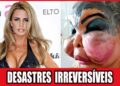 20 Desastres Chocantes De Cirurgia Plástica Em Celebridades | Antes E Depois 2026!
