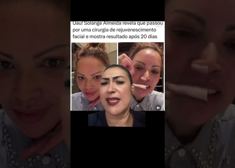 Solange almeida rejuvenesce após novo procedimento estético #noticias #fofoca #solangealmeida