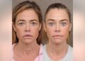Denise Richards diz que o resultado da transformação do facelift foi 'chocante'