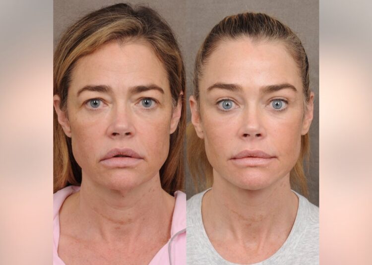 Denise Richards diz que o resultado da transformação do facelift foi 'chocante'