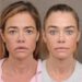 Denise Richards diz que o resultado da transformação do facelift foi 'chocante'