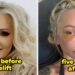 Celebridades antes e depois do facelift