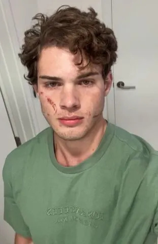 Clavicular, influenciador de 'Looksmaxxing', compartilha atualização após hospitalização 'brutal' por suspeita de overdose durante transmissão ao vivo
