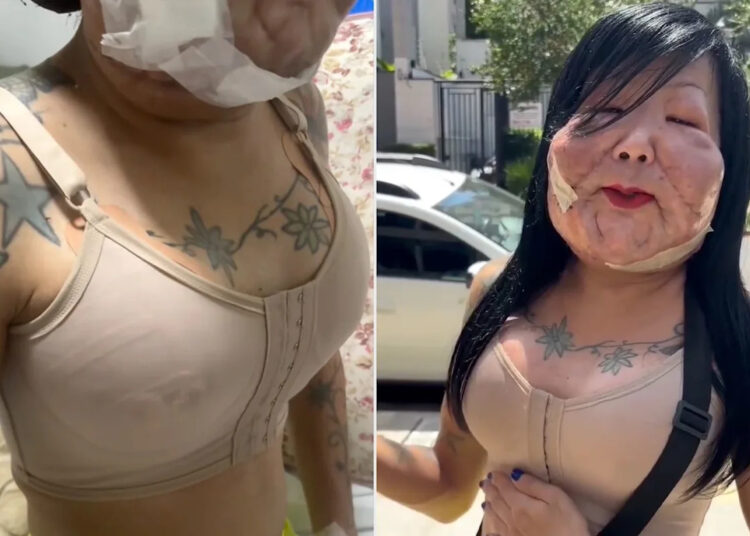 Influenciadora recebe aumento de mama do mesmo cirurgião que reconstruiu seu rosto após um trabalho mal feito