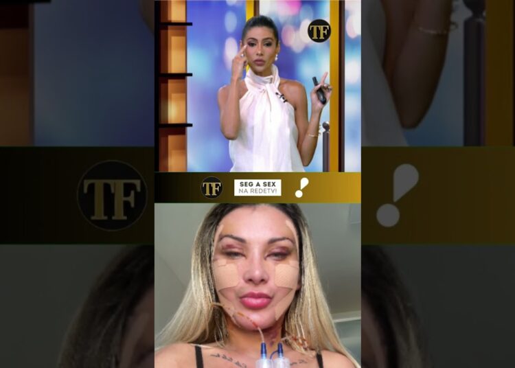 Cirurgia para rejuvenescimento? Andressa Urach investe R$ 100 mil em procedimento no rosto