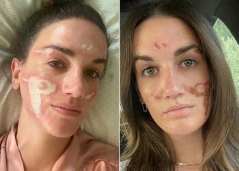 Celebridade facialista supostamente renuncia às licenças meses depois que o cliente a acusou de desfigurar a pele com um peeling químico