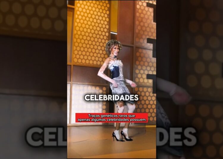 Celebridades com Traços Genéticos Raros. #brasil #celebridades #star
