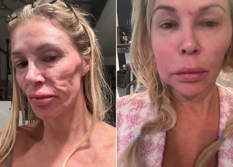 Brandi Glanville diz que é 'frustrante' que os médicos não 'acompanham' a desfiguração facial: 'Quero mais exames'