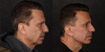 The Most Popular Men's Plastic Surgery Procedures Right Now