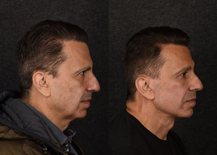 The Most Popular Men's Plastic Surgery Procedures Right Now